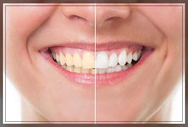 staining of tooth