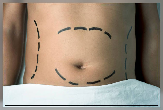 Belly fat 3