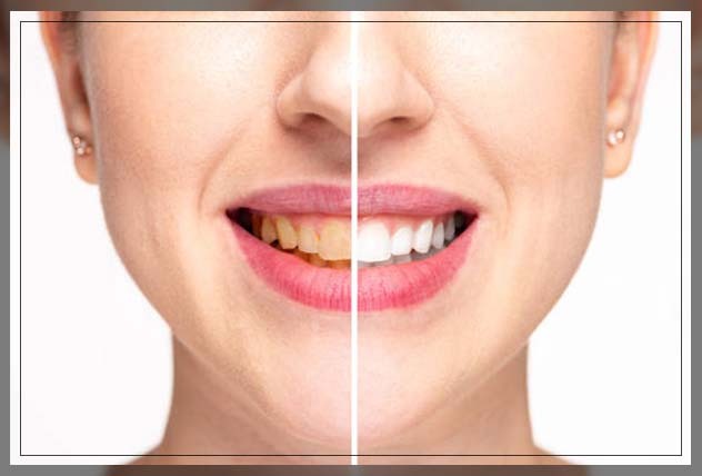 Teeth whitening Dubai 1