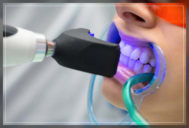 Teeth whitening Dubai 5