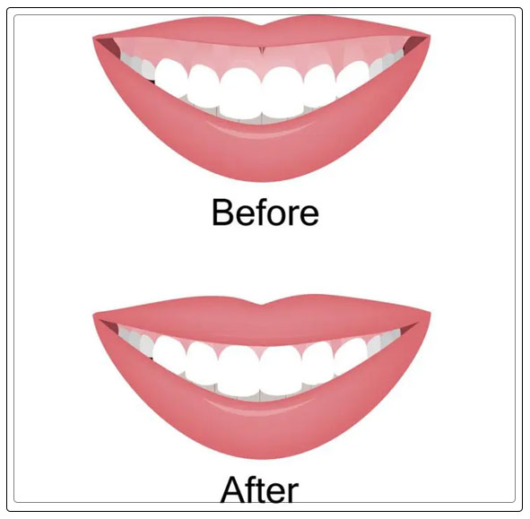 benefits of gummy smile botox procedure