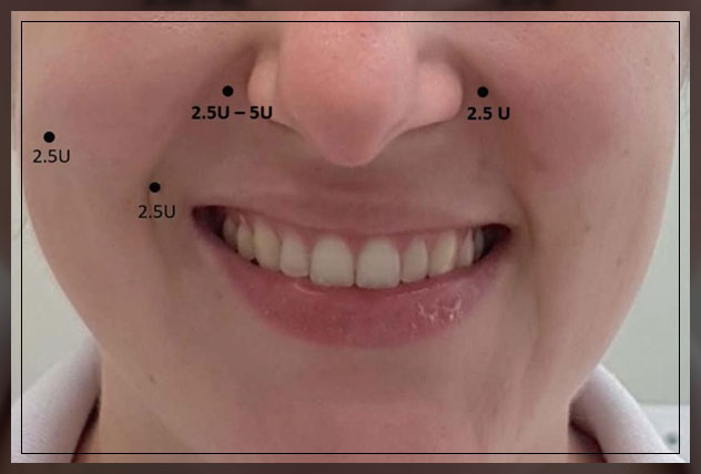 lifting of upper lip