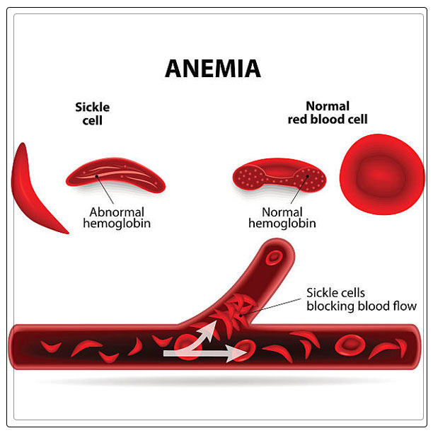 sickle cell diseases