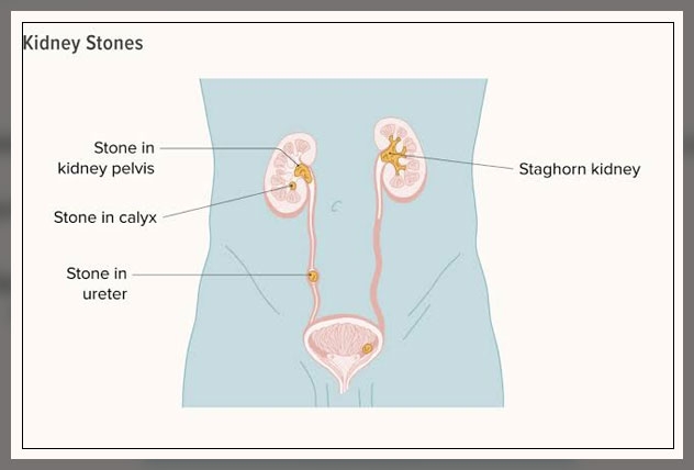 kidney infection 2