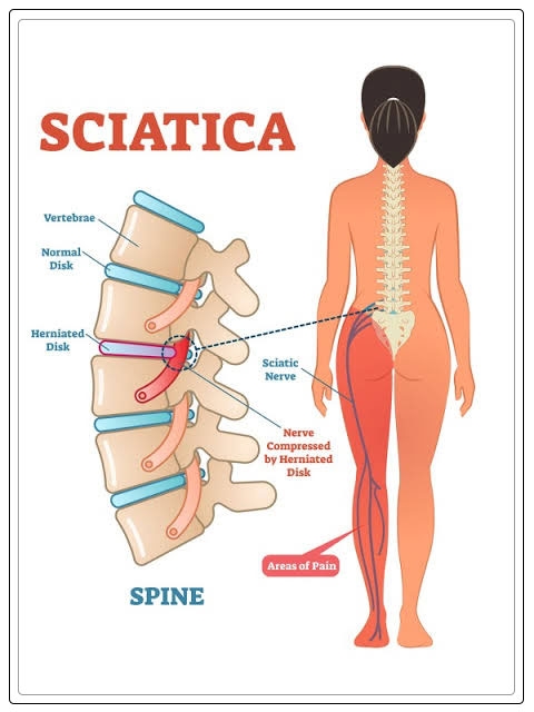 sciatica pain 1