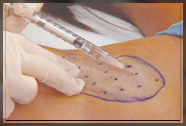 underarm botox procedure side effects